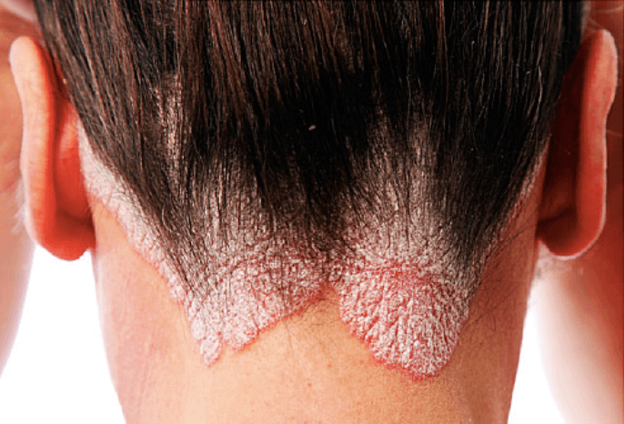 remèdes naturels psoriasis