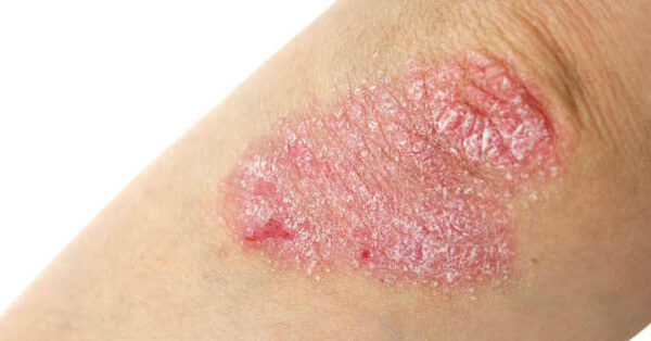 soigner eczema aloe vera