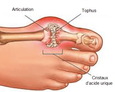 remède crise de gouttes